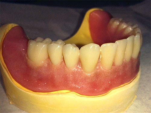 Upper Teeth Extraction For Dentures Perkinsville VT 5151